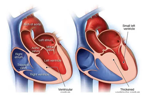 structural-heart-disease